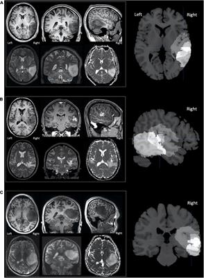 The Effect of Right Temporal Lobe Gliomas on Left and Right Hemisphere Neural Processing During Speech Perception and Production Tasks